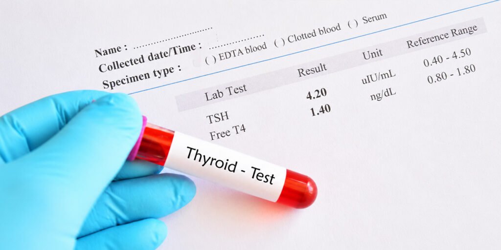 TSH test